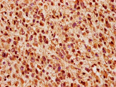 IHC image of CSB-PA026123LA01HU diluted at 1:200 and staining in paraffin-embedded human glioma performed on a Leica BondTM system. After dewaxing and hydration, antigen retrieval was mediated by high pressure in a citrate buffer (pH 6.0). Section was blocked with 10% normal goat serum 30min at RT. Then primary antibody (1% BSA) was incubated at 4&deg;C overnight. The primary is detected by a biotinylated secondary antibody and visualized using an HRP conjugated SP system.