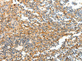 The image on the left is immunohistochemistry of paraffin-embedded Human tonsil tissue using CSB-PA026205(DTX3 Antibody) at dilution 1/20, on the right is treated with fusion protein. (Original magnification: ×200)