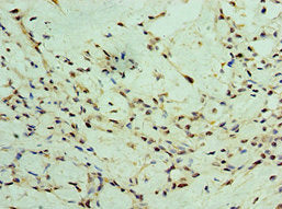 Immunohistochemistry of paraffin-embedded human breast cancer using CSB-PA026425DSR2HU at dilution of 1:100