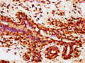 IHC image of CSB-PA026914LA01HU diluted at 1:200 and staining in paraffin-embedded human breast cancer performed on a Leica BondTM system. After dewaxing and hydration, antigen retrieval was mediated by high pressure in a citrate buffer (pH 6.0). Section was blocked with 10% normal goat serum 30min at RT. Then primary antibody (1% BSA) was incubated at 4°C overnight. The primary is detected by a biotinylated secondary antibody and visualized using an HRP conjugated SP system.