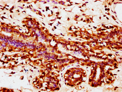 IHC image of CSB-PA026914LA01HU diluted at 1:200 and staining in paraffin-embedded human breast cancer performed on a Leica BondTM system. After dewaxing and hydration, antigen retrieval was mediated by high pressure in a citrate buffer (pH 6.0). Section was blocked with 10% normal goat serum 30min at RT. Then primary antibody (1% BSA) was incubated at 4°C overnight. The primary is detected by a biotinylated secondary antibody and visualized using an HRP conjugated SP system.