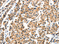 The image on the left is immunohistochemistry of paraffin-embedded Human breast cancer tissue using CSB-PA027191(XBP1 Antibody) at dilution 1/60, on the right is treated with fusion protein. (Original magnification: ×200)
