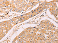 The image on the left is immunohistochemistry of paraffin-embedded Human breast cancer tissue using CSB-PA027485(ADH1B Antibody) at dilution 1/40, on the right is treated with synthetic peptide. (Original magnification: ×200)
