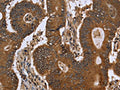 The image on the left is immunohistochemistry of paraffin-embedded Human colon cancer tissue using CSB-PA028033(FGFRL1 Antibody) at dilution 1/40, on the right is treated with fusion protein. (Original magnification: ×200)
