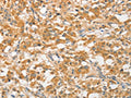 The image on the left is immunohistochemistry of paraffin-embedded Human thyroid cancer tissue using CSB-PA028037(ATG5 Antibody) at dilution 1/40, on the right is treated with fusion protein. (Original magnification: ×200)