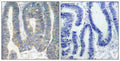Immunohistochemical analysis of paraffin-embedded human colon carcinoma tissue using PKR(Ab-451) Antibody(left) or the same antibody preincubated with blocking peptide(right).