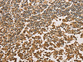 The image on the left is immunohistochemistry of paraffin-embedded Human tonsil tissue using CSB-PA028785(SETD2 Antibody) at dilution 1/40, on the right is treated with fusion protein. (Original magnification: ×200)