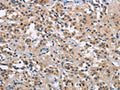 The image on the left is immunohistochemistry of paraffin-embedded Human thyroid cancer tissue using CSB-PA029620(MAPT Antibody) at dilution 1/40, on the right is treated with synthetic peptide. (Original magnification: ×200)