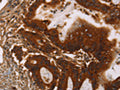 The image on the left is immunohistochemistry of paraffin-embedded Human colon cancer tissue using CSB-PA029827(GPA33 Antibody) at dilution 1/30, on the right is treated with fusion protein. (Original magnification: ×200)