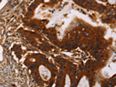 The image on the left is immunohistochemistry of paraffin-embedded Human colon cancer tissue using CSB-PA029827(GPA33 Antibody) at dilution 1/30, on the right is treated with fusion protein. (Original magnification: ×200)