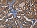 The image on the left is immunohistochemistry of paraffin-embedded Human thyroid cancer tissue using CSB-PA030360(EPHB6 Antibody) at dilution 1/40, on the right is treated with fusion protein. (Original magnification: ×200)