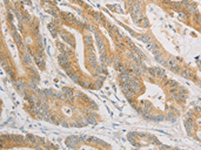 The image on the left is immunohistochemistry of paraffin-embedded Human colon cancer tissue using CSB-PA030465(ZWINT Antibody) at dilution 1/50, on the right is treated with fusion protein. (Original magnification: ×200)