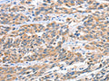 The image on the left is immunohistochemistry of paraffin-embedded Human esophagus cancer tissue using CSB-PA030984(CGB Antibody) at dilution 1/60, on the right is treated with fusion protein. (Original magnification: ×200)