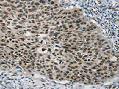 The image on the left is immunohistochemistry of paraffin-embedded Human esophagus cancer tissue using CSB-PA031035(SART3 Antibody) at dilution 1/20, on the right is treated with synthetic peptide. (Original magnification: ×200)