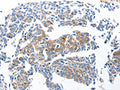 The image on the left is immunohistochemistry of paraffin-embedded Human lung cancer tissue using CSB-PA031049(Ccl6 Antibody) at dilution 1/50, on the right is treated with synthetic peptide. (Original magnification: ×200)