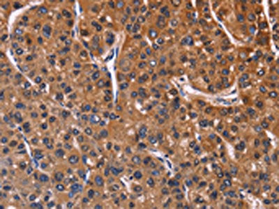 The image on the left is immunohistochemistry of paraffin-embedded Human liver cancer tissue using CSB-PA031193(NFATC3 Antibody) at dilution 1/60, on the right is treated with fusion protein. (Original magnification: ×200)