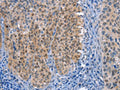 The image on the left is immunohistochemistry of paraffin-embedded Human cervical cancer tissue using CSB-PA031673(UCK1 Antibody) at dilution 1/50, on the right is treated with fusion protein. (Original magnification: ×200)