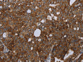 The image on the left is immunohistochemistry of paraffin-embedded Human ovarian cancer tissue using CSB-PA031676(HMGCR Antibody) at dilution 1/20, on the right is treated with fusion protein. (Original magnification: ×200)