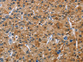 The image on the left is immunohistochemistry of paraffin-embedded Human liver cancer tissue using CSB-PA031920(NCR3 Antibody) at dilution 1/40, on the right is treated with fusion protein. (Original magnification: ×200)