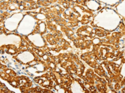 The image on the left is immunohistochemistry of paraffin-embedded Human thyroid cancer tissue using CSB-PA032335(FZD6 Antibody) at dilution 1/60, on the right is treated with synthetic peptide. (Original magnification: ×200)