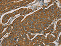 The image on the left is immunohistochemistry of paraffin-embedded Human breast cancer tissue using CSB-PA032496(NPPB Antibody) at dilution 1/30, on the right is treated with fusion protein. (Original magnification: ×200)