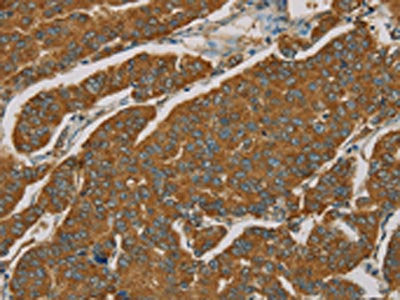 The image on the left is immunohistochemistry of paraffin-embedded Human breast cancer tissue using CSB-PA032496(NPPB Antibody) at dilution 1/30, on the right is treated with fusion protein. (Original magnification: ×200)