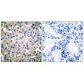 Immunohistochemical analysis of paraffin-embedded human breast carcinoma tissue using Transglutaminase 2 antibody.