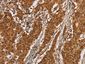 The image on the left is immunohistochemistry of paraffin-embedded Human gastic cancer tissue using CSB-PA032717(IL17RA Antibody) at dilution 1/20, on the right is treated with synthetic peptide. (Original magnification: ×200)