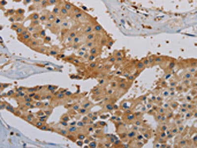 The image on the left is immunohistochemistry of paraffin-embedded Human prostate cancer tissue using CSB-PA032730(IGFBP1 Antibody) at dilution 1/20, on the right is treated with synthetic peptide. (Original magnification: ×200)