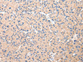 The image on the left is immunohistochemistry of paraffin-embedded Human liver cancer tissue using CSB-PA032749(DUSP11 Antibody) at dilution 1/25, on the right is treated with fusion protein. (Original magnification: ×200)