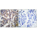 Immunohistochemical analysis of paraffin-embedded human breast carcinoma tissue using Keratin 20 antibody.