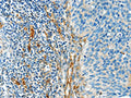 The image on the left is immunohistochemistry of paraffin-embedded Human cervical cancer tissue using CSB-PA033015(DIO2 Antibody) at dilution 1/50, on the right is treated with synthetic peptide. (Original magnification: X200)