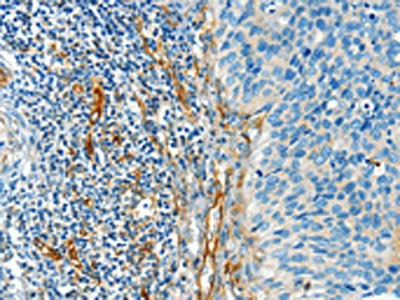 The image on the left is immunohistochemistry of paraffin-embedded Human cervical cancer tissue using CSB-PA033015(DIO2 Antibody) at dilution 1/50, on the right is treated with synthetic peptide. (Original magnification: X200)
