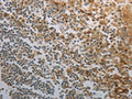 The image on the left is immunohistochemistry of paraffin-embedded Human tonsil tissue using CSB-PA033184(INHA Antibody) at dilution 1/150, on the right is treated with fusion protein. (Original magnification: ×200)