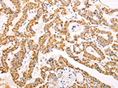 The image on the left is immunohistochemistry of paraffin-embedded Human thyroid cancer tissue using CSB-PA033338(ATPIF1 Antibody) at dilution 1/60, on the right is treated with fusion protein. (Original magnification: ×200)