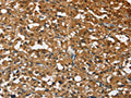 The image on the left is immunohistochemistry of paraffin-embedded Human thyroid cancer tissue using CSB-PA033399(STK17B Antibody) at dilution 1/40, on the right is treated with fusion protein. (Original magnification: ×200)