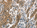 The image on the left is immunohistochemistry of paraffin-embedded Human gastic cancer tissue using CSB-PA033427(SMAD3 Antibody) at dilution 1/30, on the right is treated with synthetic peptide. (Original magnification: ×200)