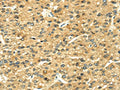 The image on the left is immunohistochemistry of paraffin-embedded Human liver cancer tissue using CSB-PA033492(LEP Antibody) at dilution 1/35, on the right is treated with fusion protein. (Original magnification: ×200)