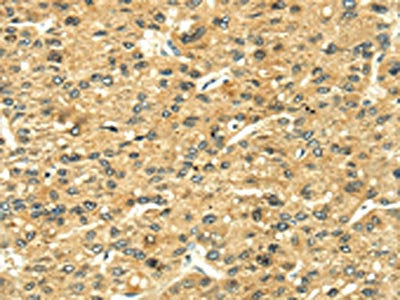The image on the left is immunohistochemistry of paraffin-embedded Human liver cancer tissue using CSB-PA033492(LEP Antibody) at dilution 1/35, on the right is treated with fusion protein. (Original magnification: ×200)
