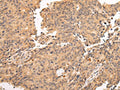 The image on the left is immunohistochemistry of paraffin-embedded Human prostate cancer tissue using CSB-PA033785(ALDH3A2 Antibody) at dilution 1/20, on the right is treated with fusion protein. (Original magnification: ×200)