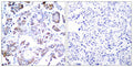 Immunohistochemical analysis of paraffin-embedded human breast carcinoma tissue using NFkB-p65(Ab-254) Antibody(left) or the same antibody preincubated with blocking peptide(right).