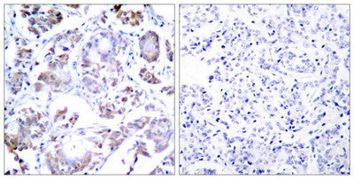 Immunohistochemical analysis of paraffin-embedded human breast carcinoma tissue using NFkB-p65(Ab-254) Antibody(left) or the same antibody preincubated with blocking peptide(right).