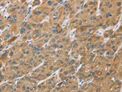 The image on the left is immunohistochemistry of paraffin-embedded Human liver cancer tissue using CSB-PA033966(CYP27A1 Antibody) at dilution 1/25, on the right is treated with fusion protein. (Original magnification: ×200)