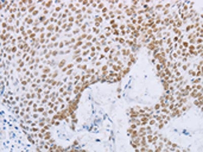The image on the left is immunohistochemistry of paraffin-embedded Human lung cancer tissue using CSB-PA033980(MCM2 Antibody) at dilution 1/50, on the right is treated with fusion protein. (Original magnification: ×200)