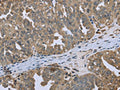 The image on the left is immunohistochemistry of paraffin-embedded Human ovarian cancer tissue using CSB-PA034013(DCTN4 Antibody) at dilution 1/50, on the right is treated with fusion protein. (Original magnification: ×200)