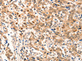 The image on the left is immunohistochemistry of paraffin-embedded Human gastic cancer tissue using CSB-PA034129(NOX4 Antibody) at dilution 1/20, on the right is treated with fusion protein. (Original magnification: ×200)