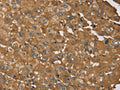 The image on the left is immunohistochemistry of paraffin-embedded Human liver cancer tissue using CSB-PA034142(RNF5 Antibody) at dilution 1/35, on the right is treated with synthetic peptide. (Original magnification: ×200)