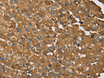 The image on the left is immunohistochemistry of paraffin-embedded Human liver cancer tissue using CSB-PA034142(RNF5 Antibody) at dilution 1/35, on the right is treated with synthetic peptide. (Original magnification: ×200)