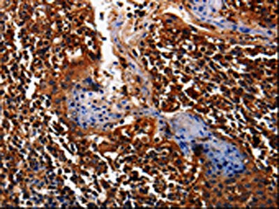 The image on the left is immunohistochemistry of paraffin-embedded Human tonsil tissue using CSB-PA034215(ALPL Antibody) at dilution 1/25, on the right is treated with fusion protein. (Original magnification: ×200)
