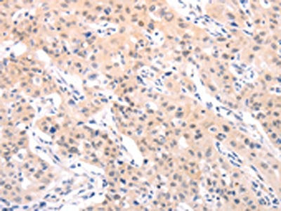 The image on the left is immunohistochemistry of paraffin-embedded Human lung cancer tissue using CSB-PA034758(TRAF2 Antibody) at dilution 1/40, on the right is treated with fusion protein. (Original magnification: ×200)